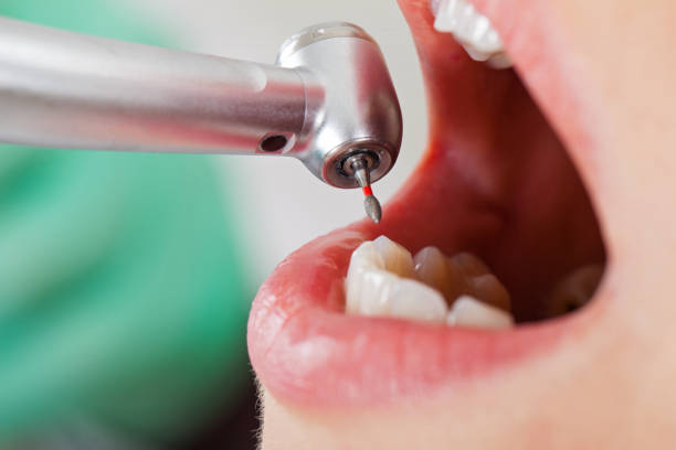 Best Emergency Root Canal Treatment in Odell, OR